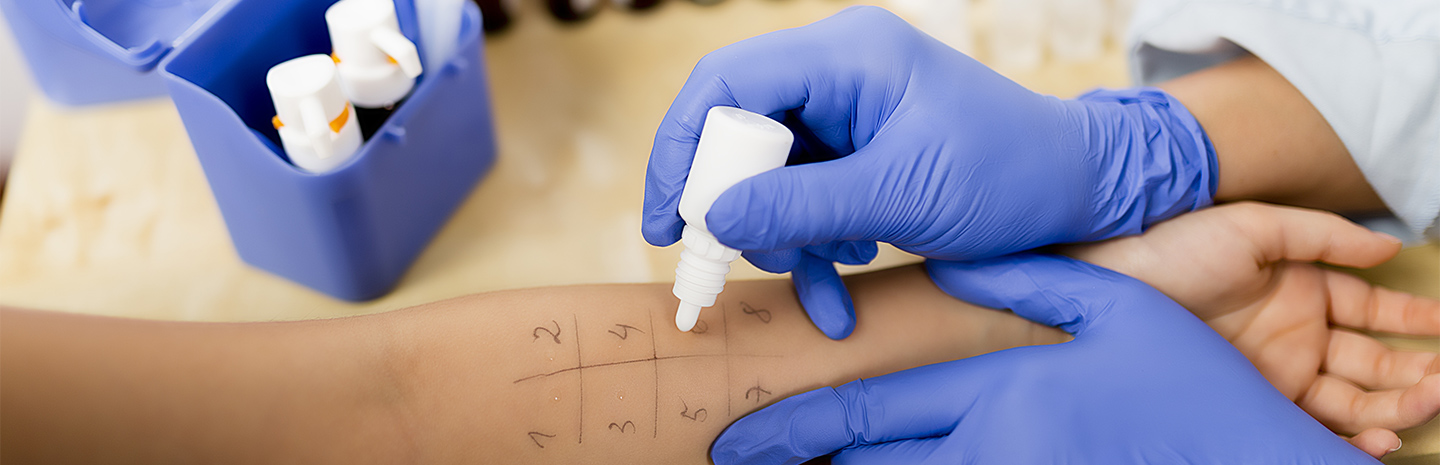 skin-prick-test-for-allergies-being-conducted
